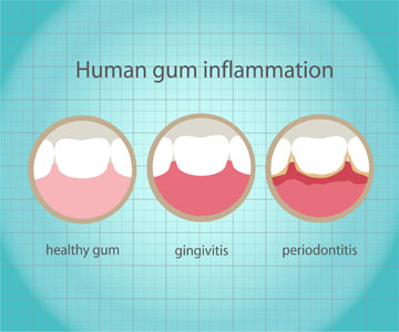 What Are The Causes And Symptoms Of Gum Disease?