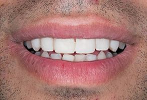 The image shows a close-up of a person s face with a smile, focusing on their teeth and lips.