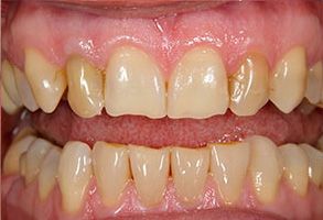 The image shows two photographs side by side on the left, a close-up of an open mouth with yellowed teeth on the right, the same mouth after dental treatment, revealing clean white teeth.