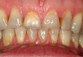 The image shows two close-up photographs of a person s teeth with visible discoloration, likely due to staining or decay, set against a plain background.