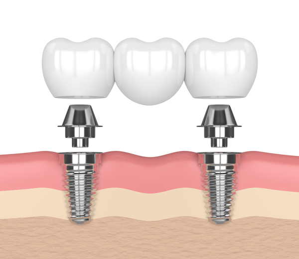 Dental Implants Honolulu, HI