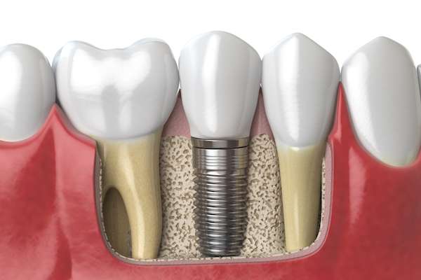 Dental Implants for Replacing Missing Teeth from Diamond Head Dental Care in Honolulu, HI