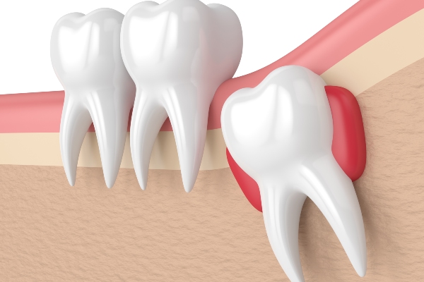 Go To An Emergency Dentistry To Deal With An Impacted Wisdom Tooth