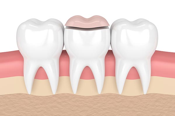 How a Cosmetic Dentist Can Place Inlays and Onlays from Diamond Head Dental Care in Honolulu, HI