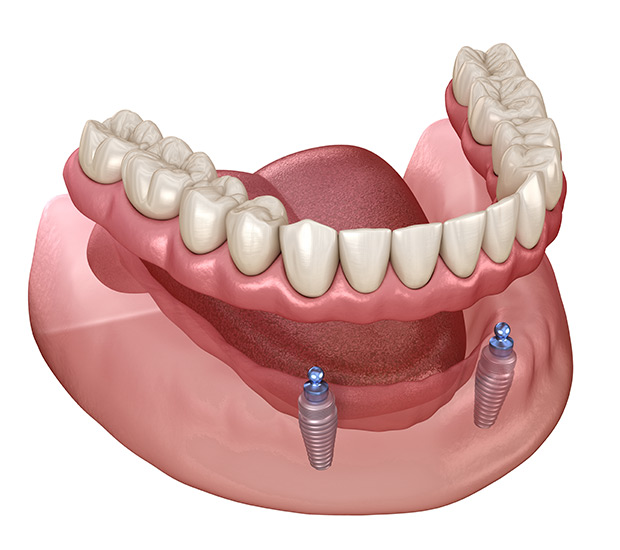 Honolulu Implant Supported Dentures