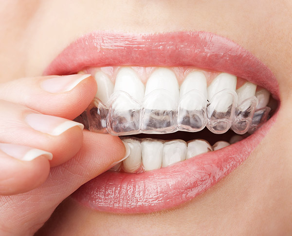 Invisalign &#    ; An Invisible Solution To Straighten Teeth