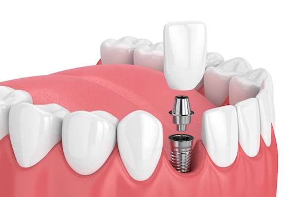 Mini vs. Regular Dental Implants from Diamond Head Dental Care in Honolulu, HI