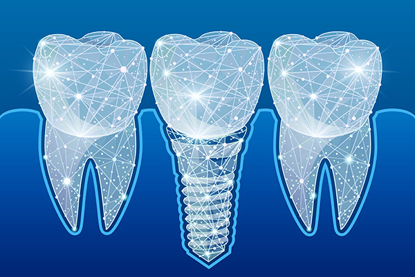 Preventing Complications After Getting Dental Implants from Diamond Head Dental Care in Honolulu, HI