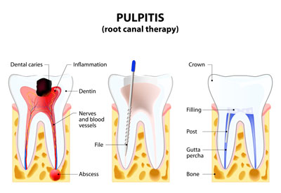Root Canal Dentist