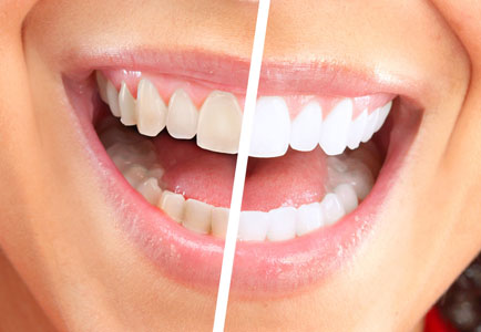 Teeth Whitening: Visiting A Dentist In Honolulu Makes A Significant Difference